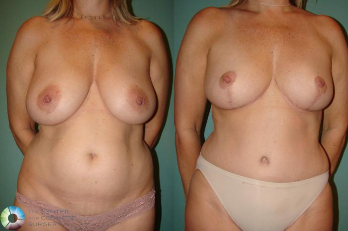 Before & After Mommy Makeover Case 10942 Anterior in Denver and Colorado Springs, CO