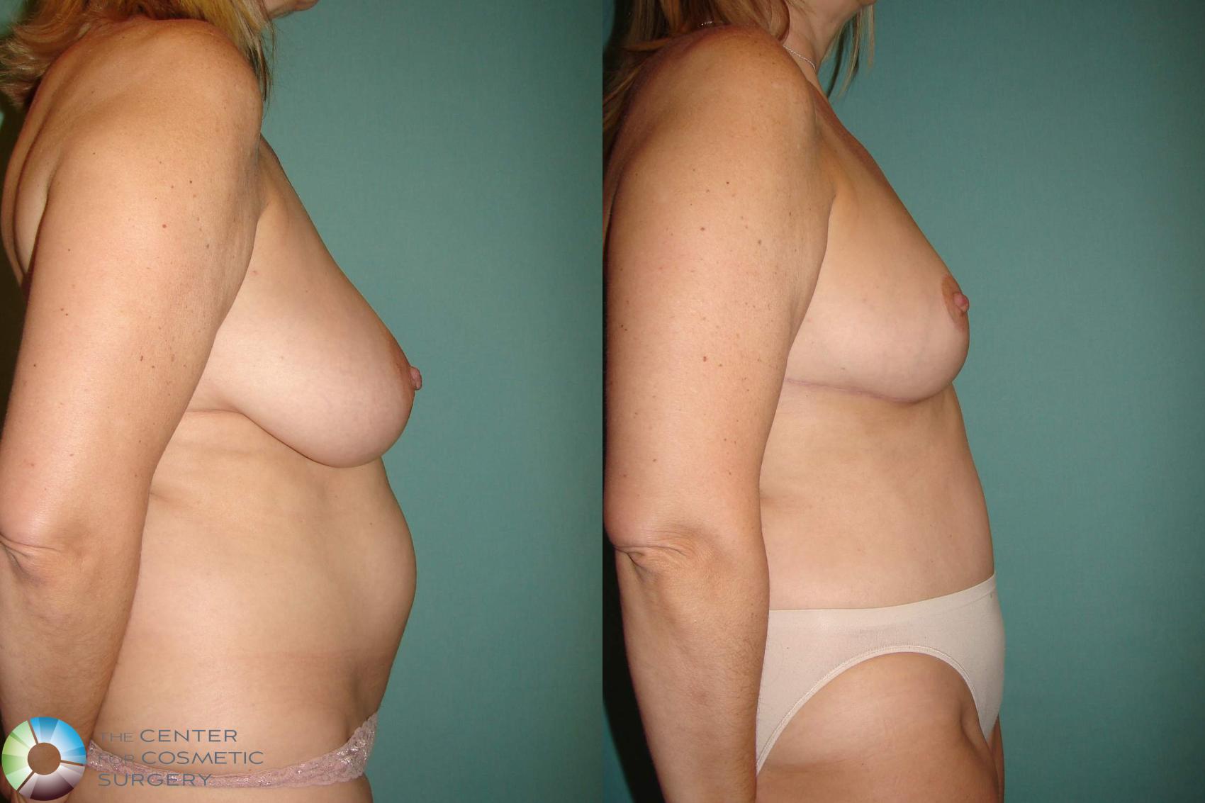 Before & After Mommy Makeover Case 10942 Right lateral in Denver and Colorado Springs, CO