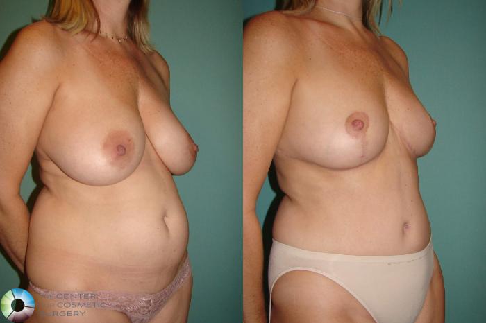 Before & After Mommy Makeover Case 10942 Right oblique in Denver and Colorado Springs, CO