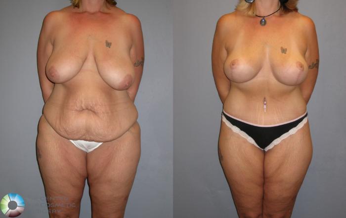 Before & After Thigh Lift Case 112 View #2 View in Golden, CO