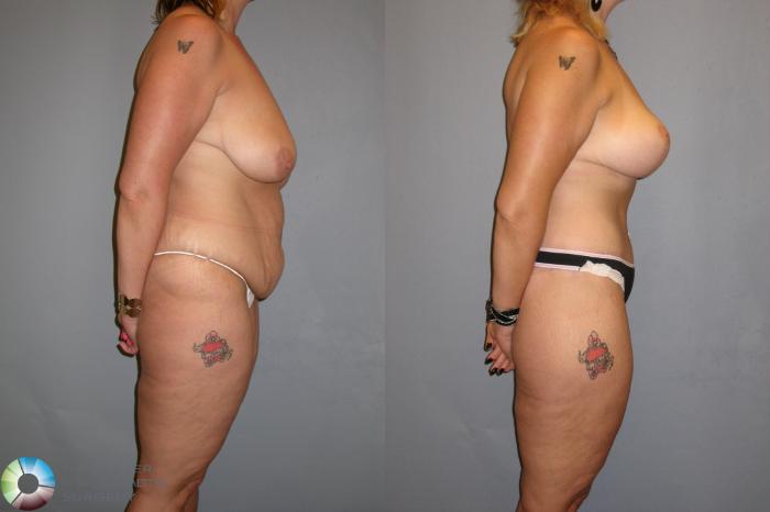 Before & After Thigh Lift Case 112 View #3 View in Golden, CO
