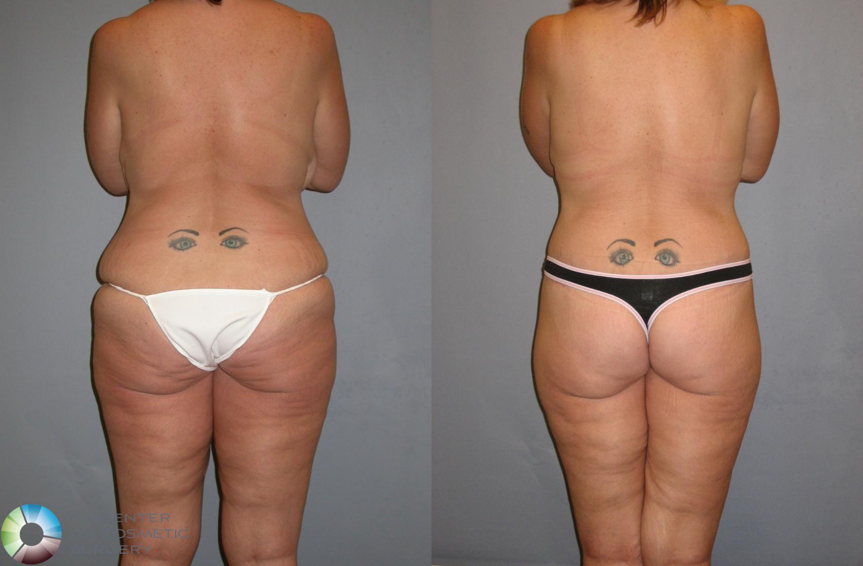 Before & After Body Lift Case 112 View #4 View in Golden, CO