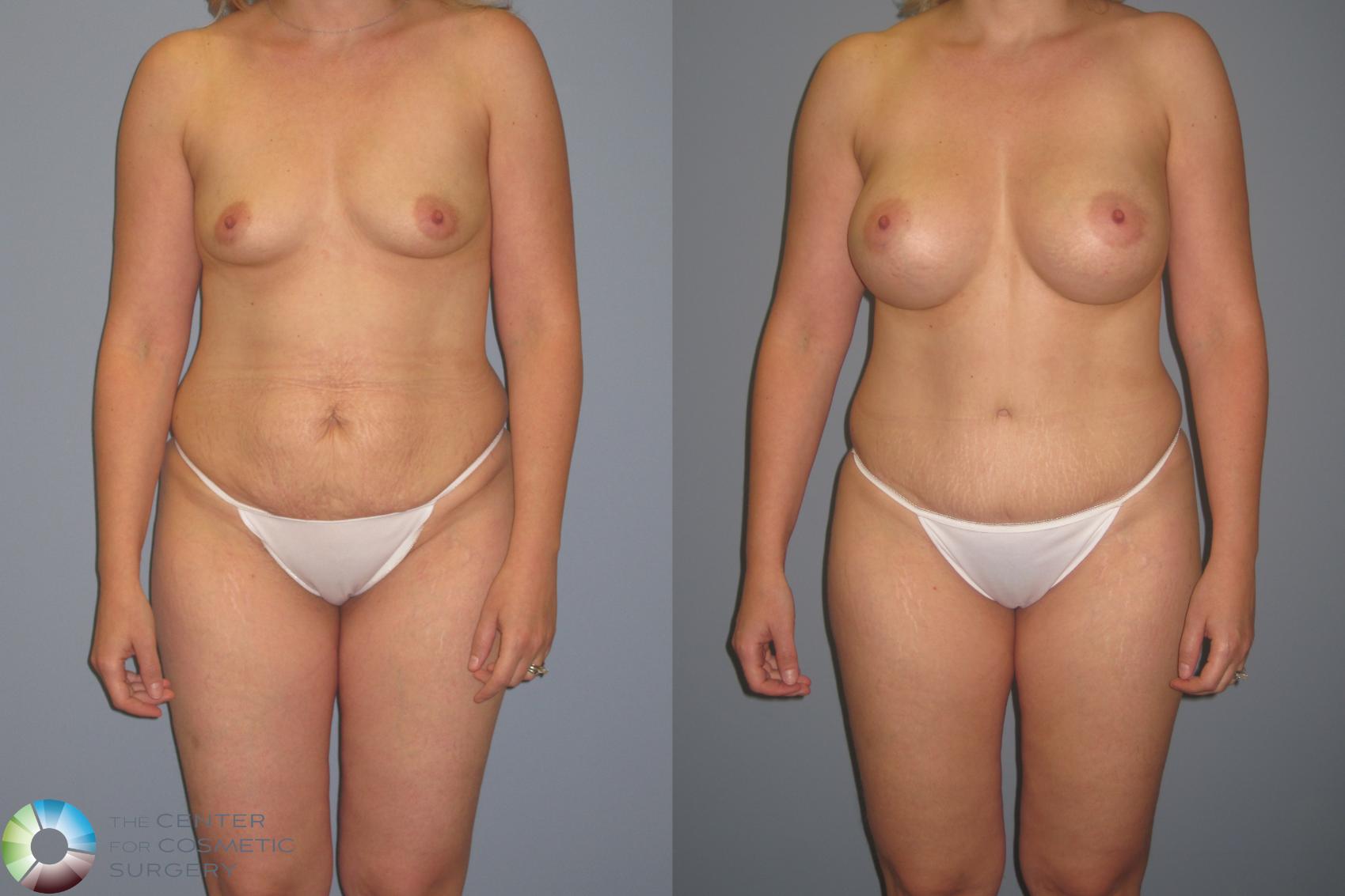 Before & After Tummy Tuck Case 11208 Front in Denver and Colorado Springs, CO