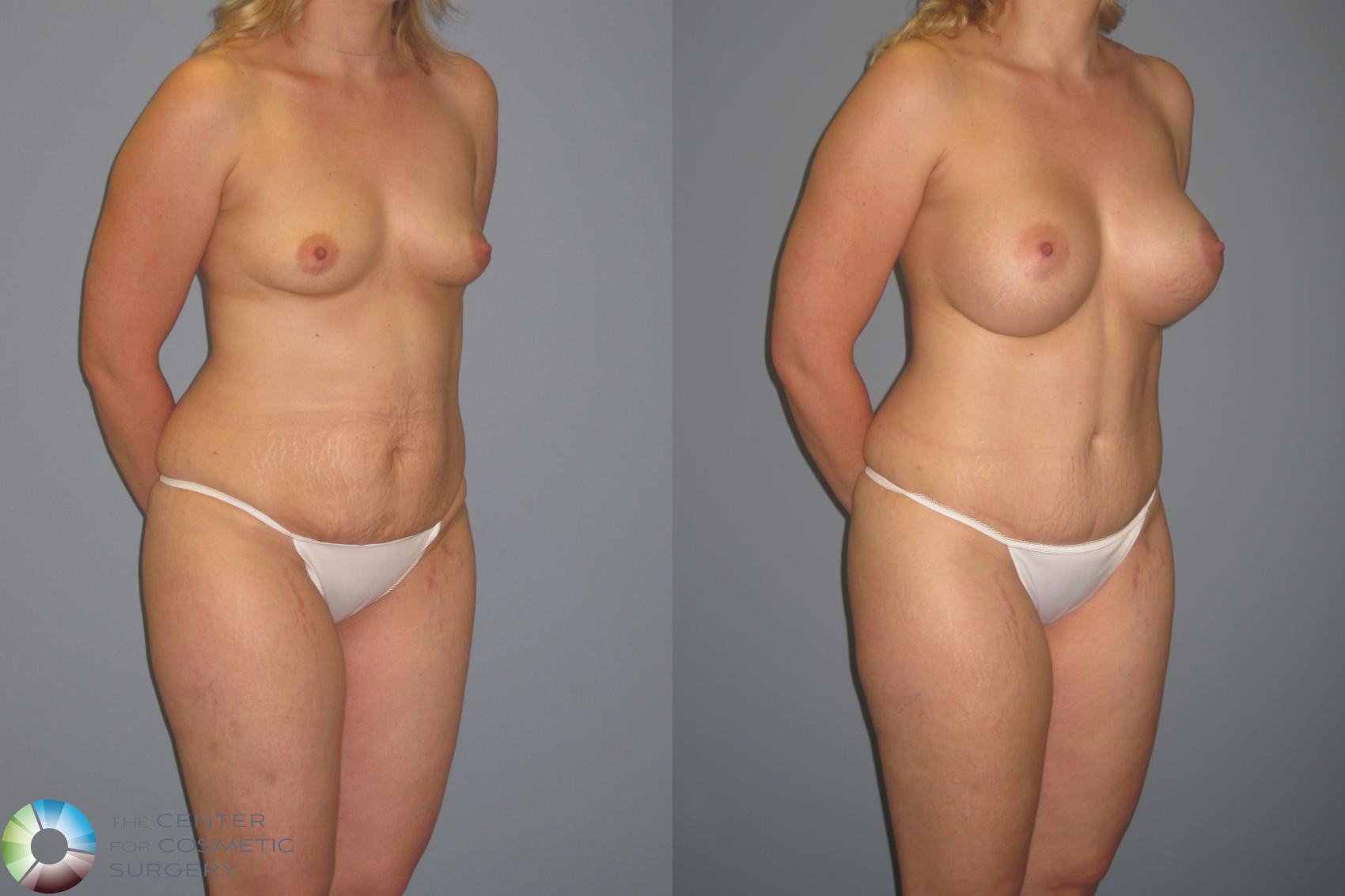 Before & After Mommy Makeover Case 11208 Right Oblique in Denver and Colorado Springs, CO