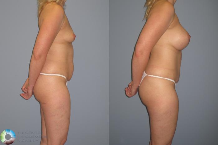 Before & After Breast Augmentation Case 11208 Right Side View in Golden, CO