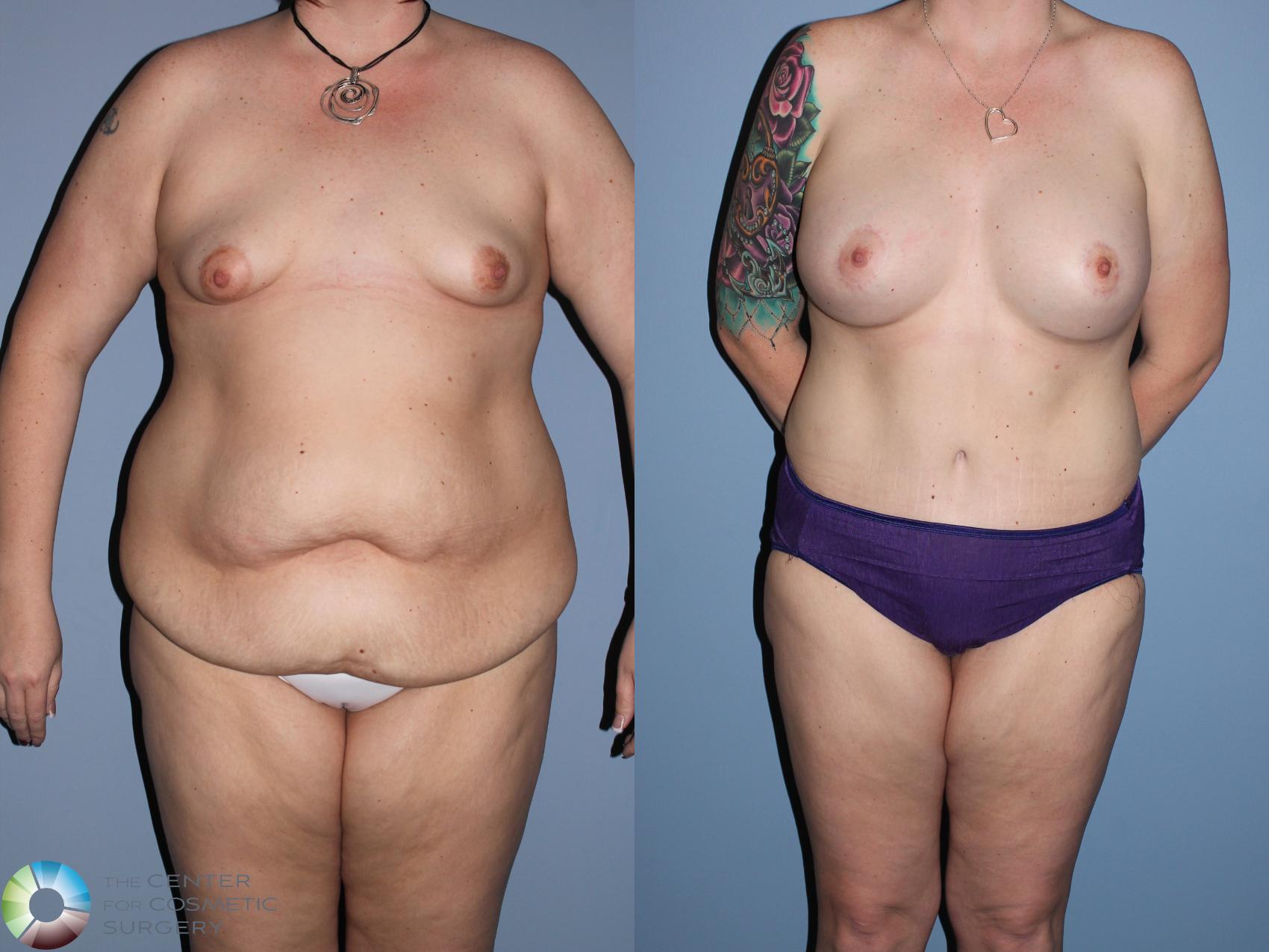 Before & After Breast Lift Case 11307 Front in Denver and Colorado Springs, CO