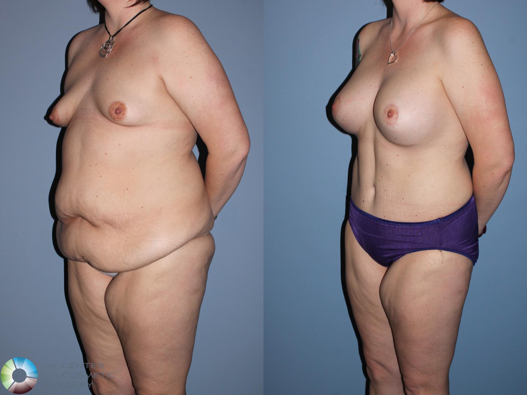 Before & After Mommy Makeover Case 11307 Left Oblique View in Golden, CO