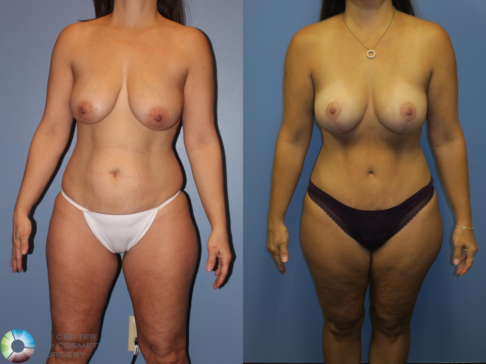 Before & After Breast Lift without Implants Case 11309 Front View in Denver & Golden, CO