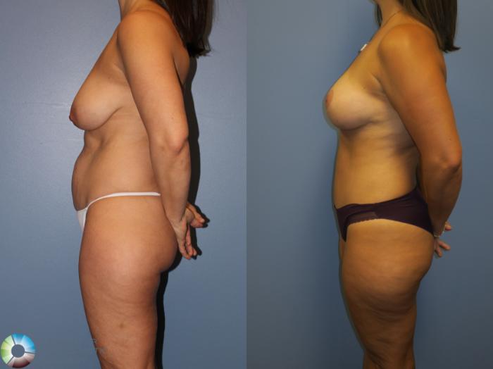 Before & After Breast Lift without Implants Case 11309 Left Side View in Golden, CO