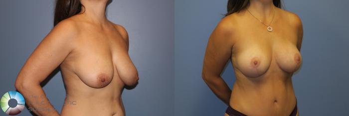 Before & After Breast Lift without Implants Case 11309 Right Oblique View in Golden, CO