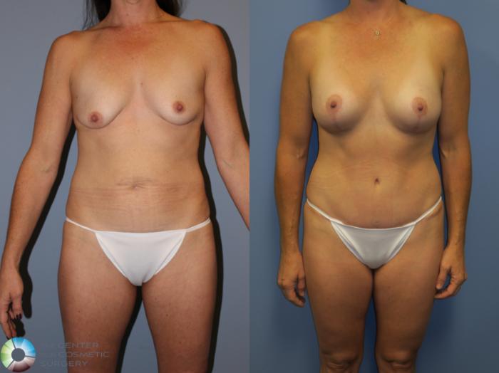 Before & After Breast Lift Case 11310 Front View in Golden, CO