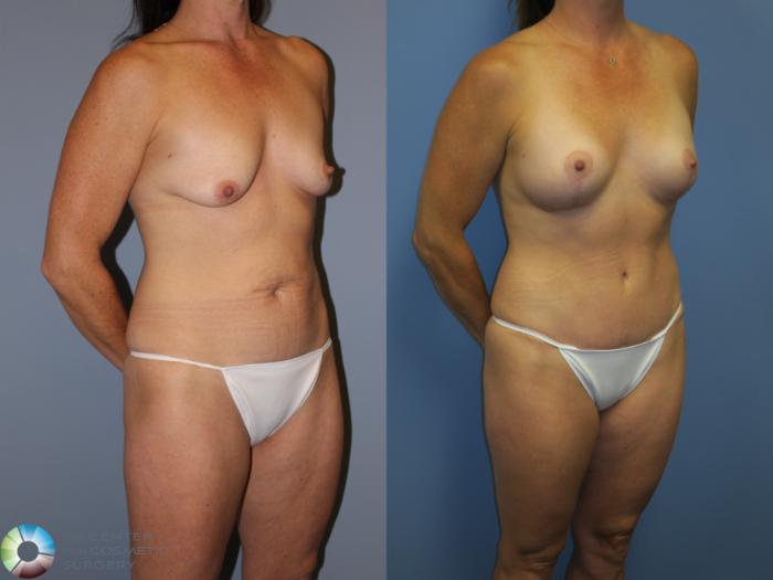 Before & After Mommy Makeover Case 11310 Right Oblique View in Golden, CO
