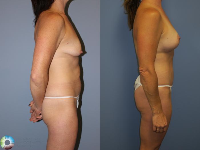Before & After Breast Lift Case 11310 Right Side View in Golden, CO