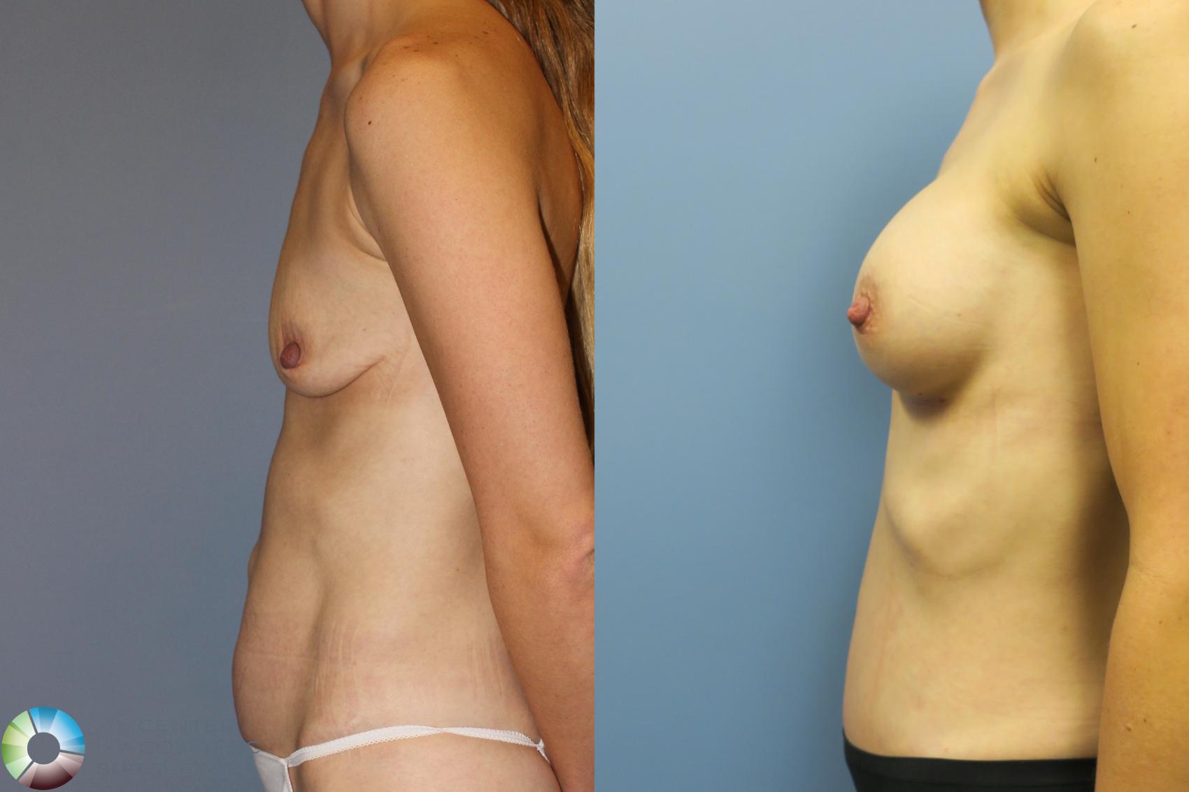 Before & After Mommy Makeover Case 11312 Left Side in Denver and Colorado Springs, CO