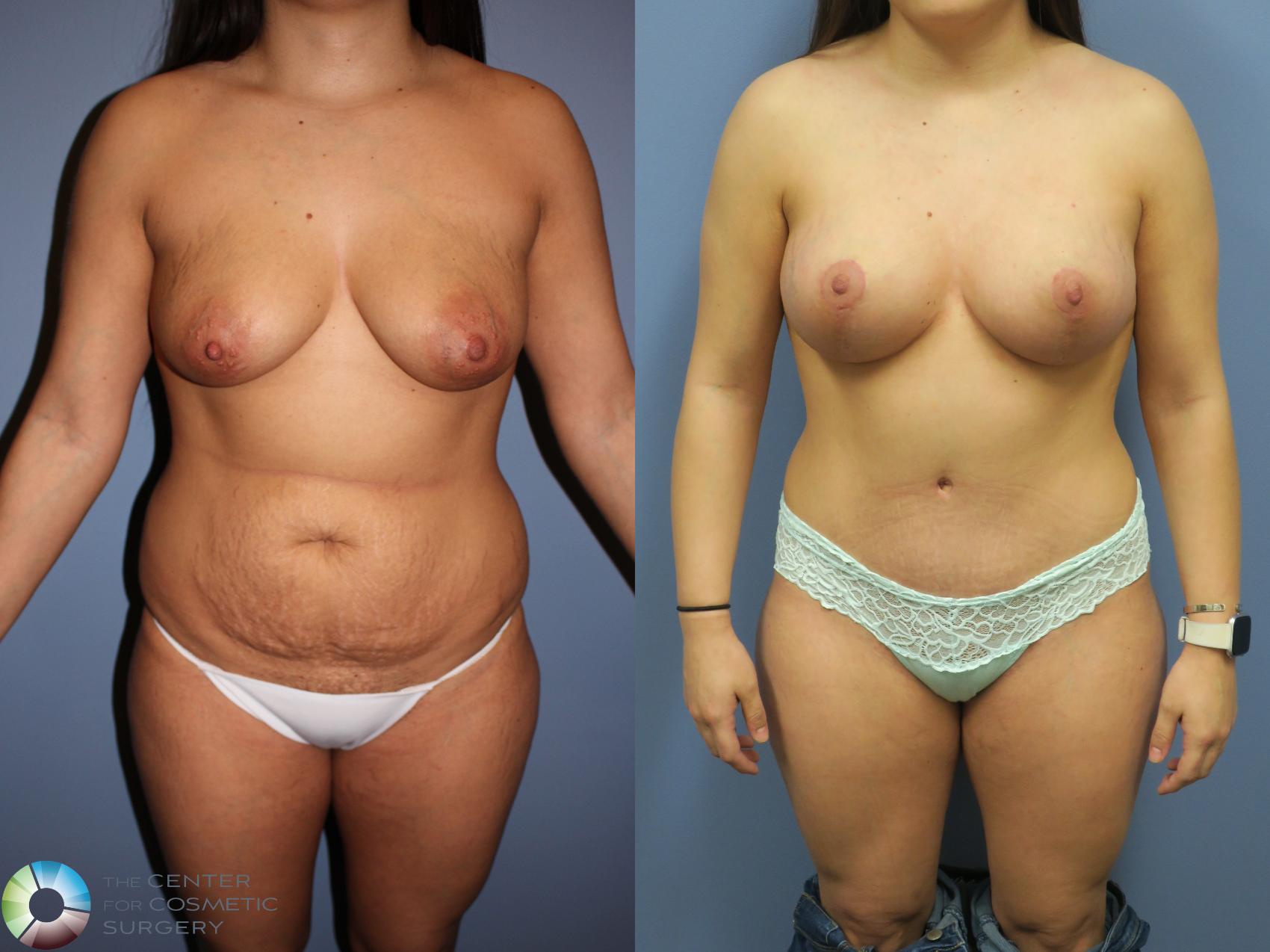 Before & After Breast Lift Case 11313 Front in Denver, CO