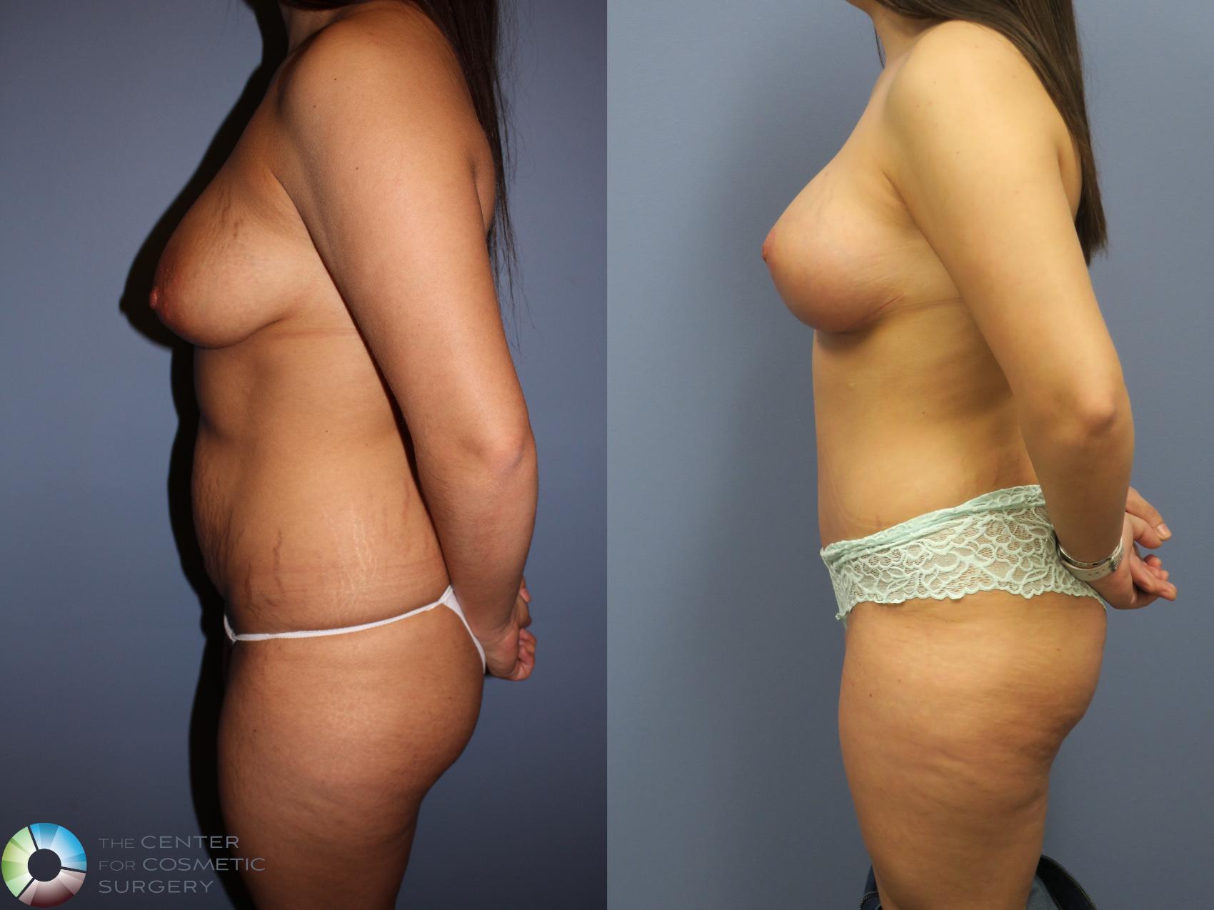 Before & After Mommy Makeover Case 11313 Left Side in Denver and Colorado Springs, CO