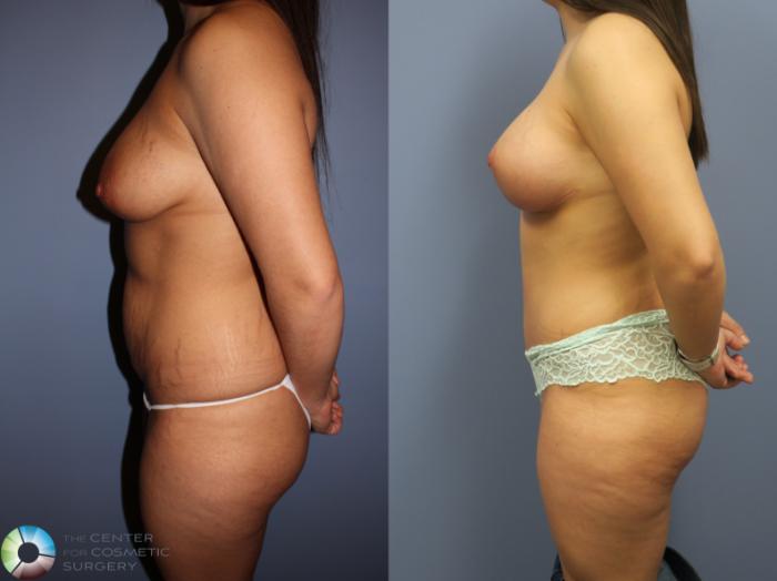 Before & After Breast Lift Case 11313 Left Side View in Golden, CO