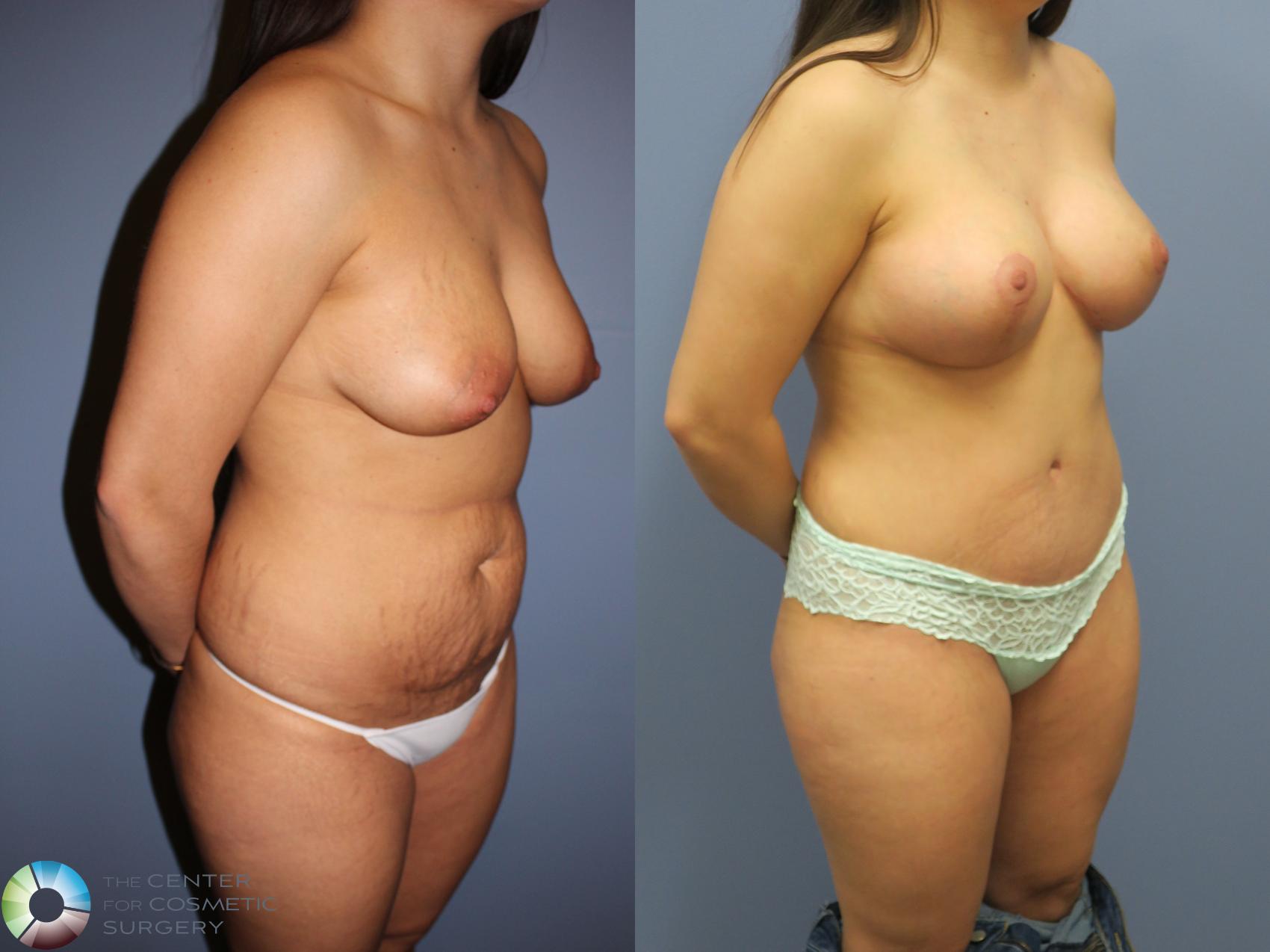 Before & After Mommy Makeover Case 11313 Right Oblique in Denver and Colorado Springs, CO