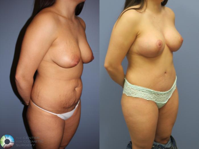 Before & After Mommy Makeover Case 11313 Right Oblique View in Golden, CO