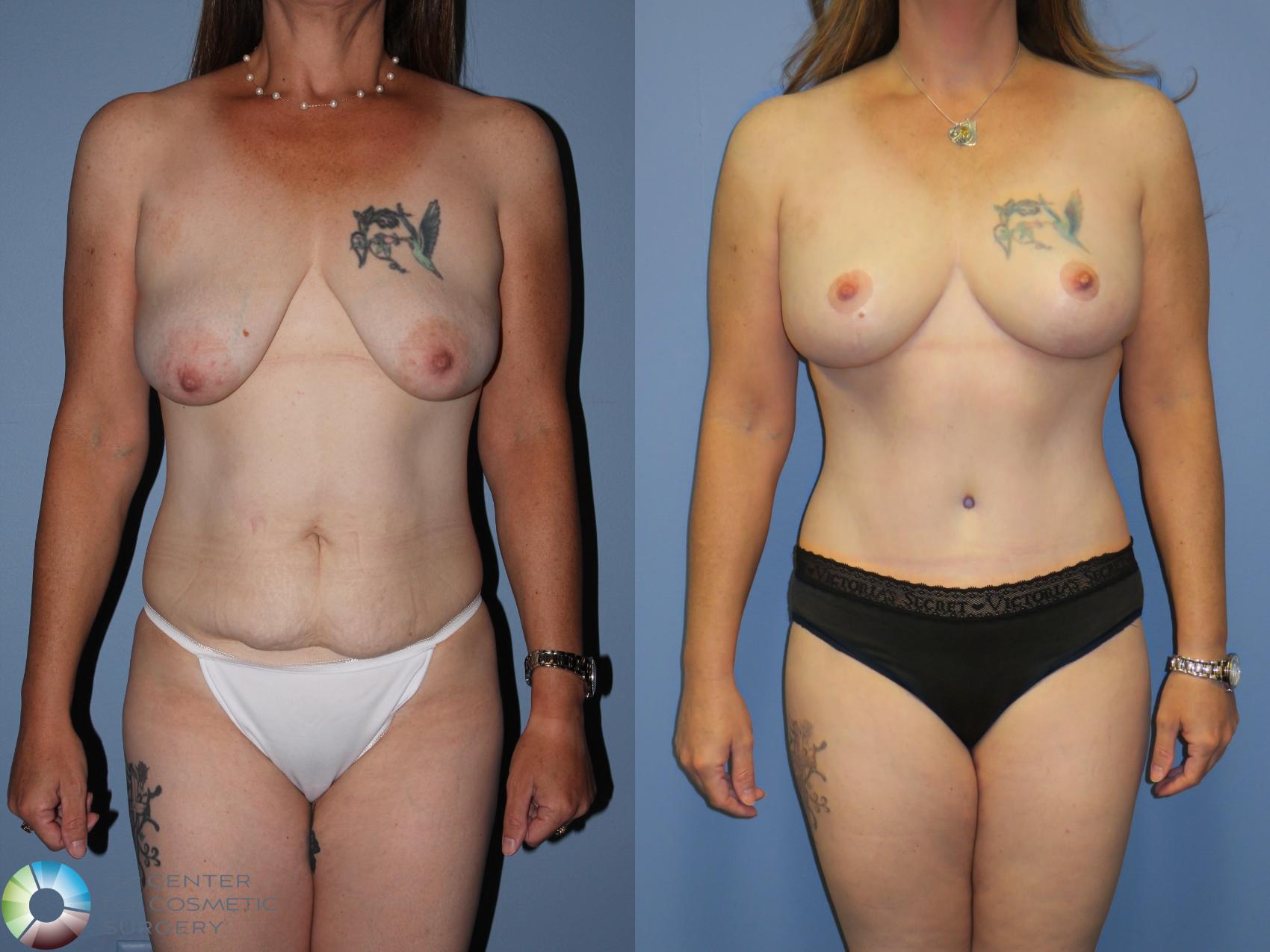 Before & After Breast Lift without Implants Case 11314 Front in Denver and Colorado Springs, CO