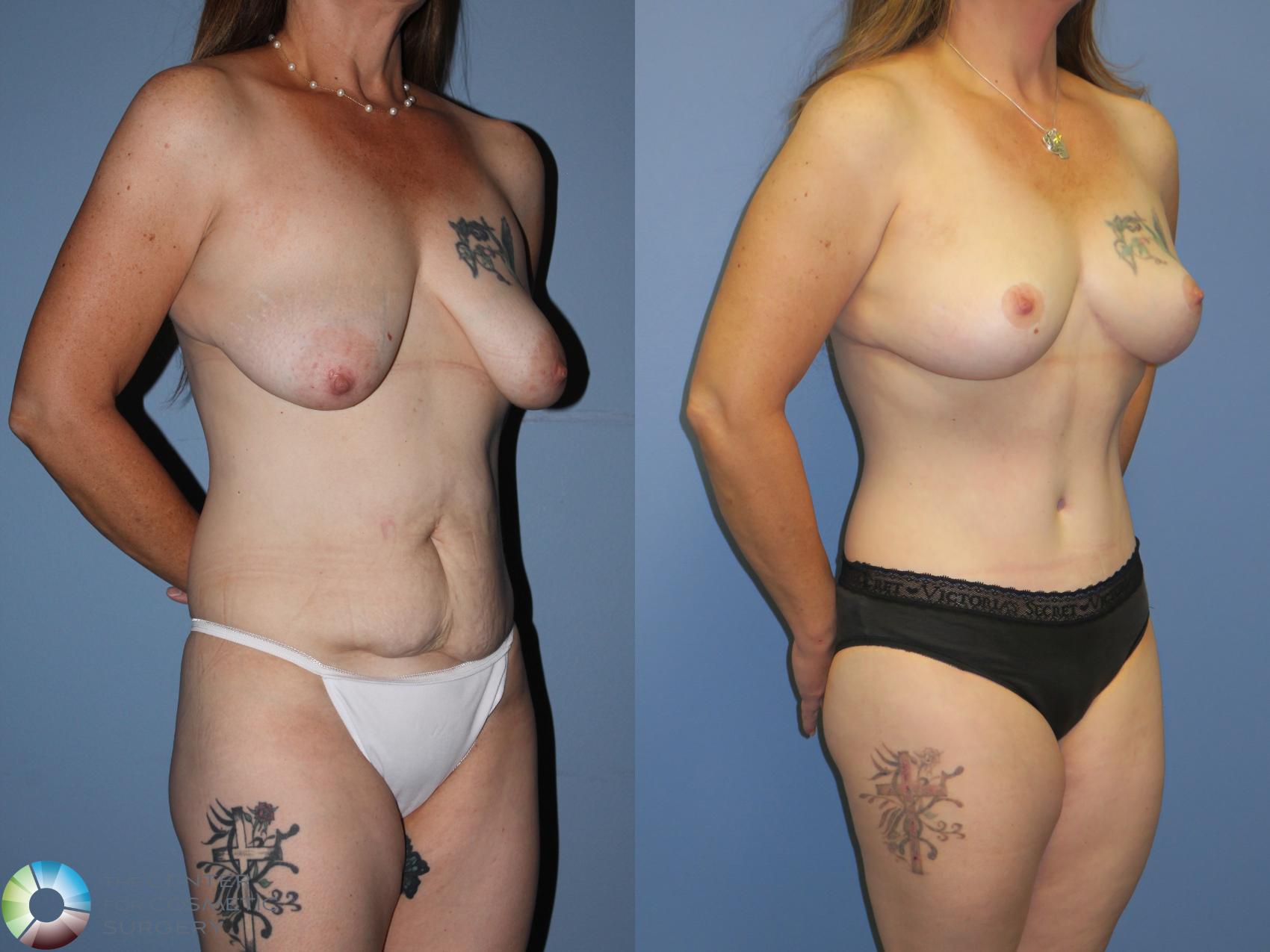 Before & After Mommy Makeover Case 11314 Right Oblique View in Denver & Golden, CO