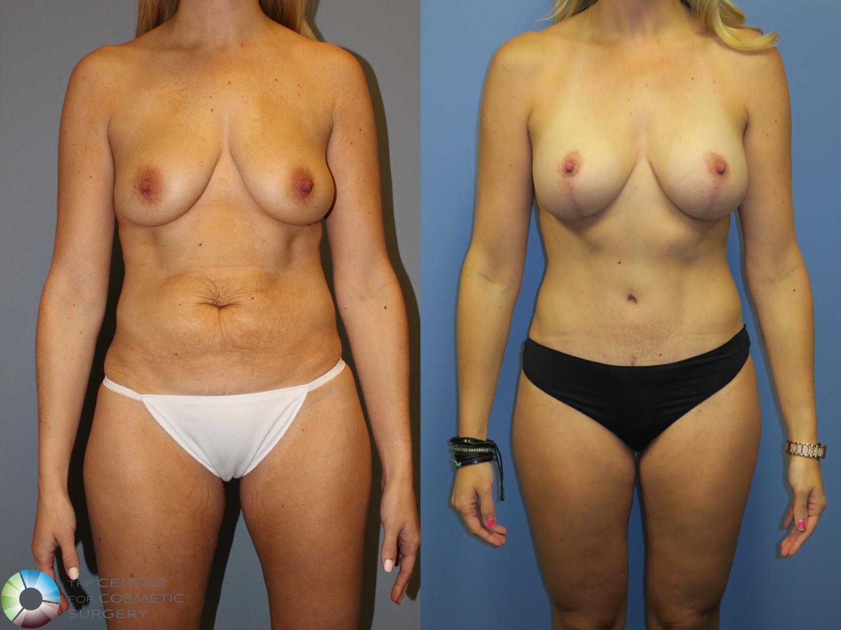 Before & After Mommy Makeover Case 11315 Front in Denver and Colorado Springs, CO