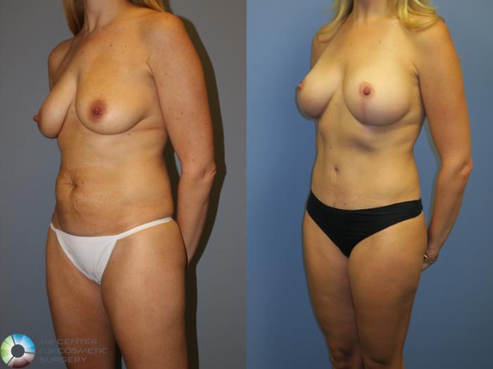 Before & After Tummy Tuck Case 11315 Left Oblique View in Golden, CO