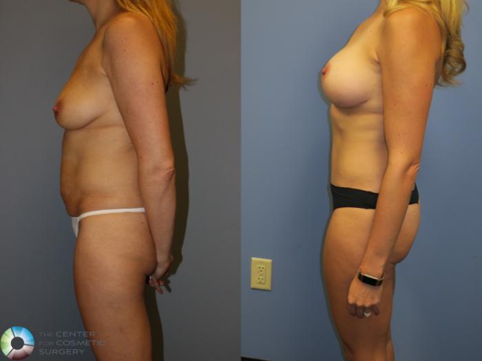 Before & After Mommy Makeover Case 11315 Left Side View in Golden, CO