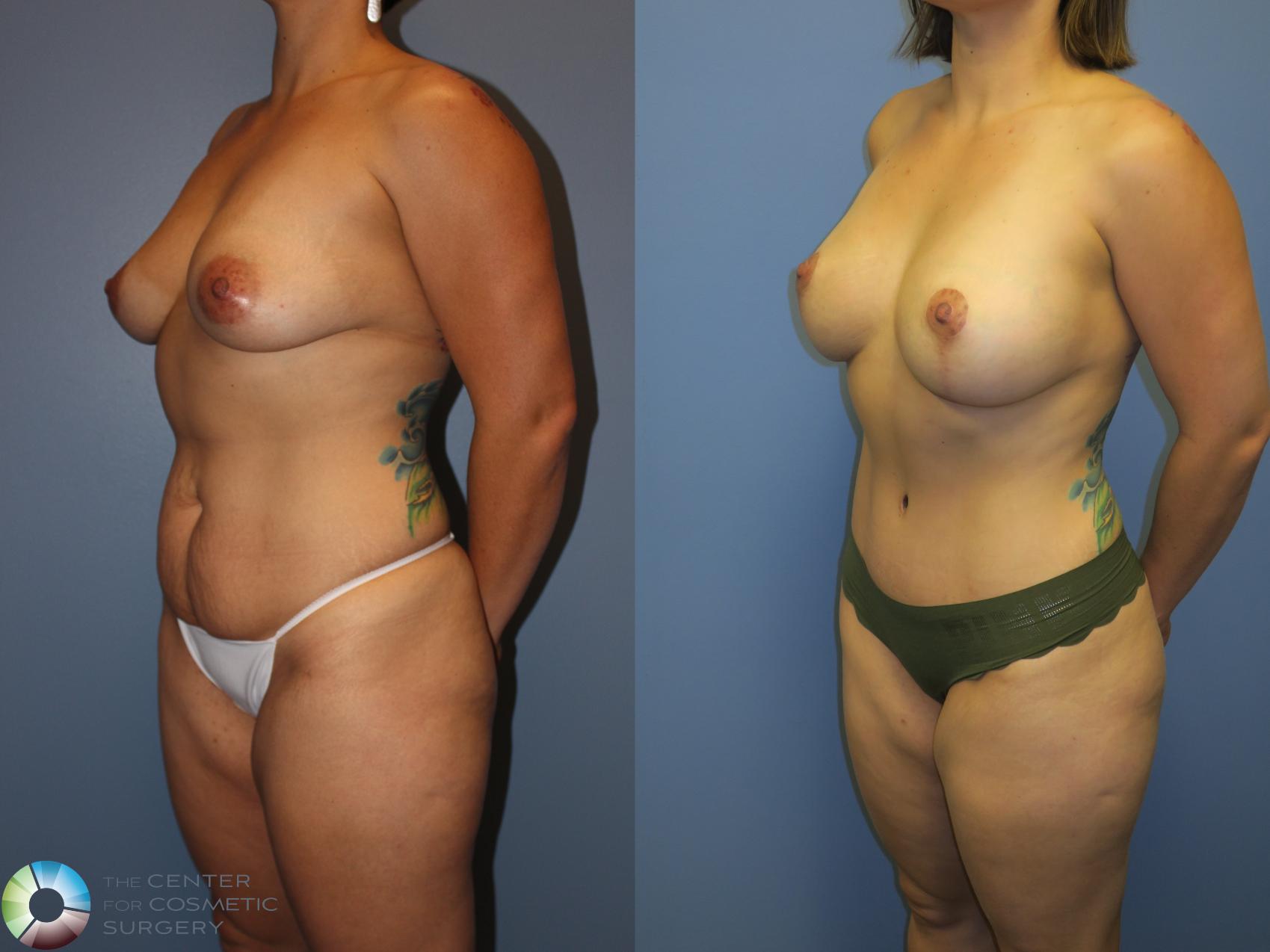 Before & After Tummy Tuck Case 11346 Left Oblique View in Golden, CO