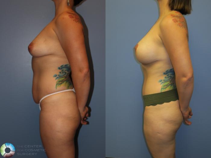 Before & After Tummy Tuck Case 11346 Left Side View in Golden, CO