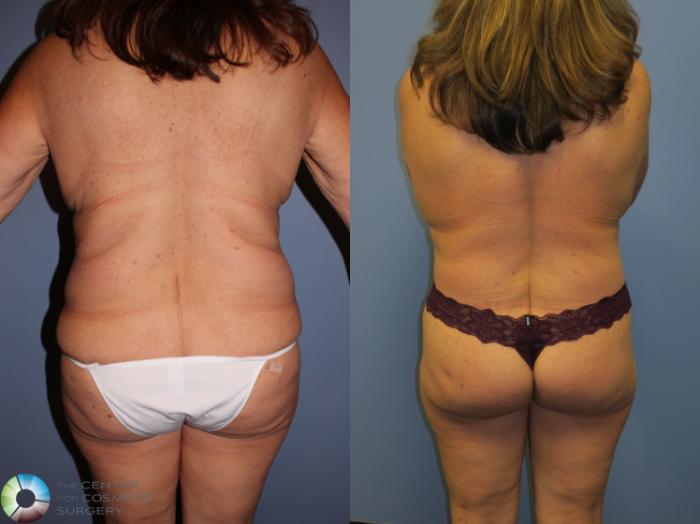 Before & After Breast Lift Case 11347 Back View in Golden, CO