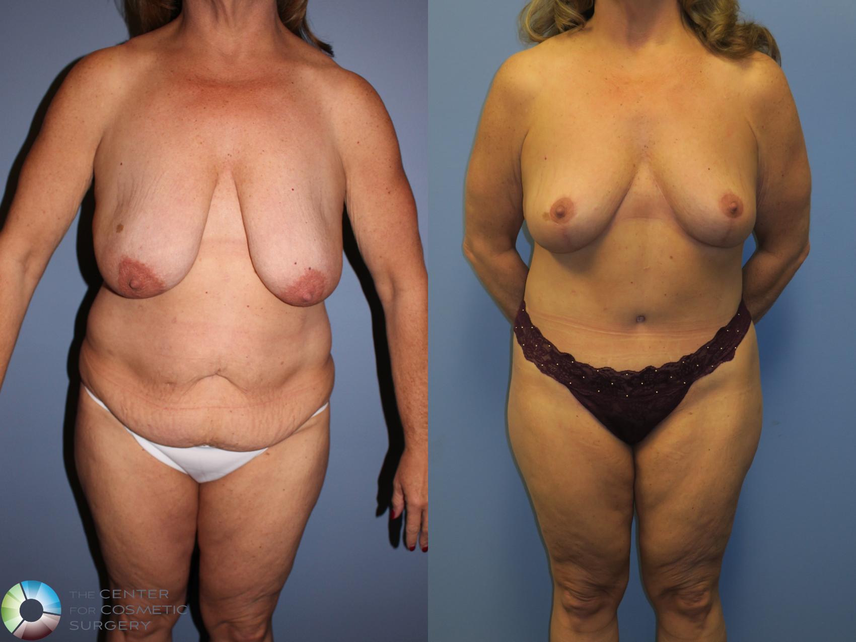 Before & After Mommy Makeover Case 11347 Front View in Golden, CO