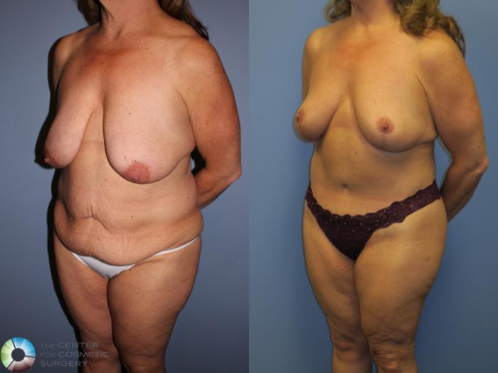 Before & After Breast Lift Case 11347 Left Oblique View in Golden, CO