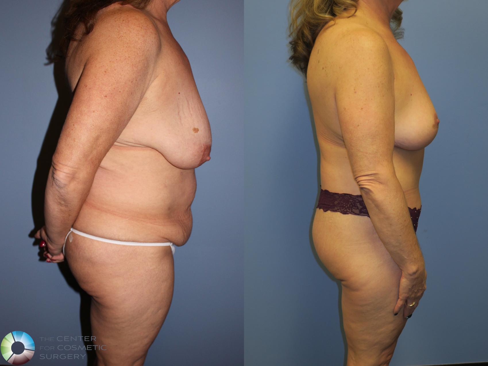 Before & After Body Lift Case 11347 Right Side View in Golden, CO