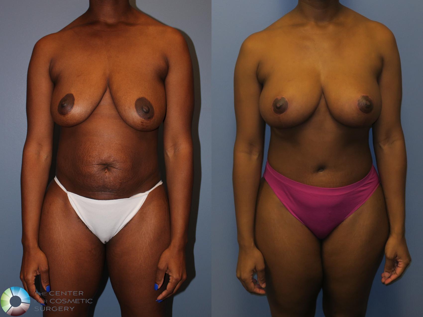 Before & After Mommy Makeover Case 11348 Front in Denver and Colorado Springs, CO