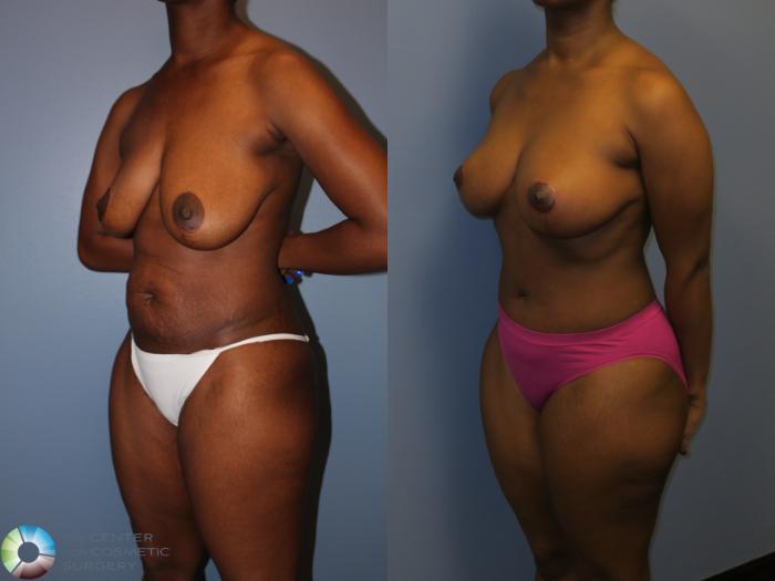 Before & After Mommy Makeover Case 11348 Left Oblique View in Golden, CO