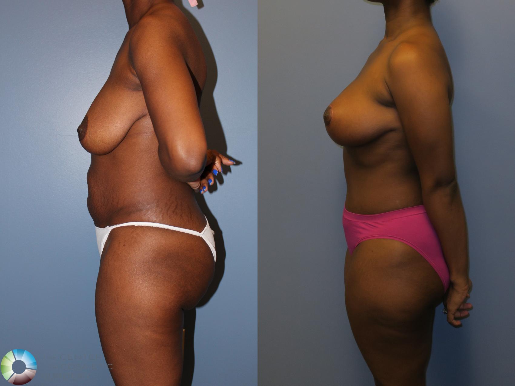Before & After Mommy Makeover Case 11348 Left Side in Denver and Colorado Springs, CO