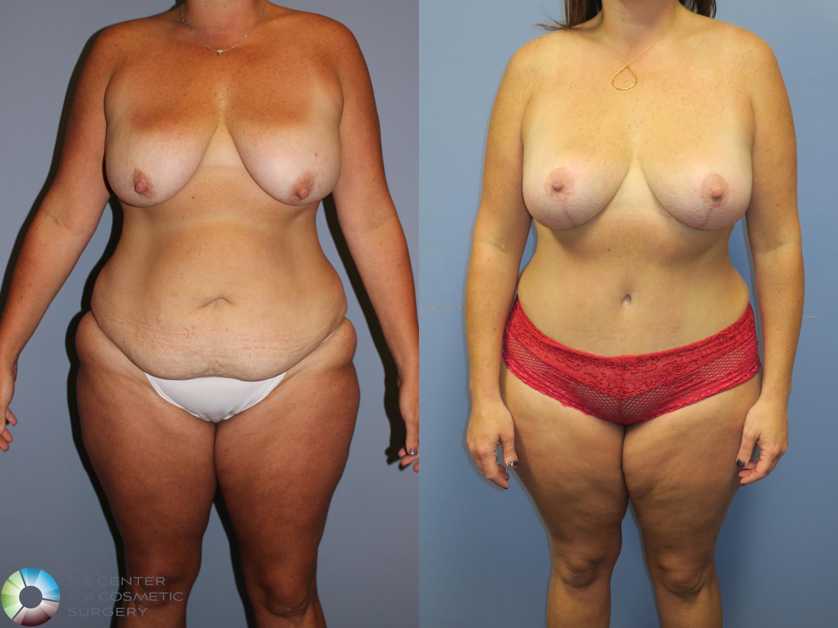 Before & After Breast Lift without Implants Case 11349 Front in Denver and Colorado Springs, CO