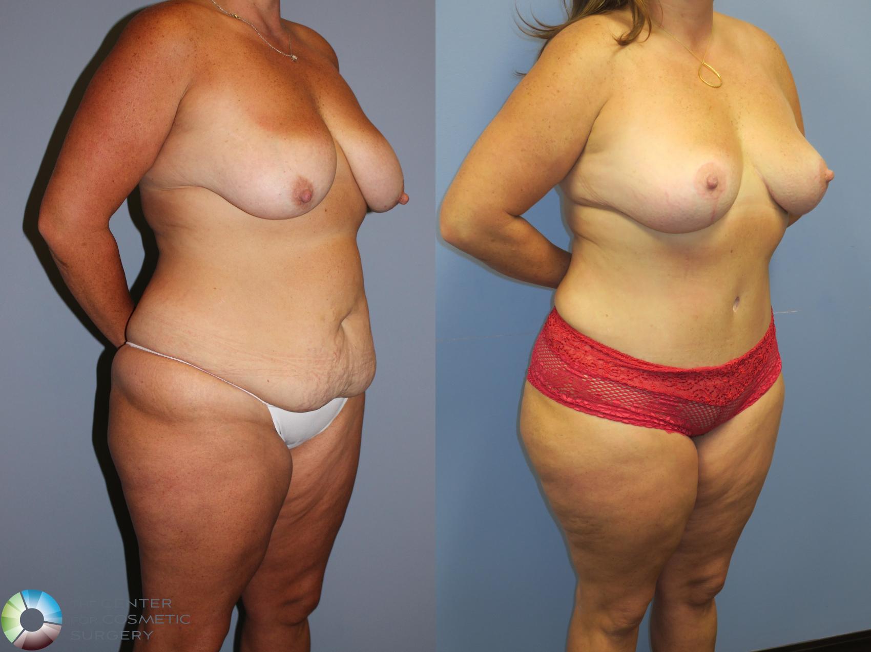 Before & After Mommy Makeover Case 11349 Right Oblique View in Golden, CO