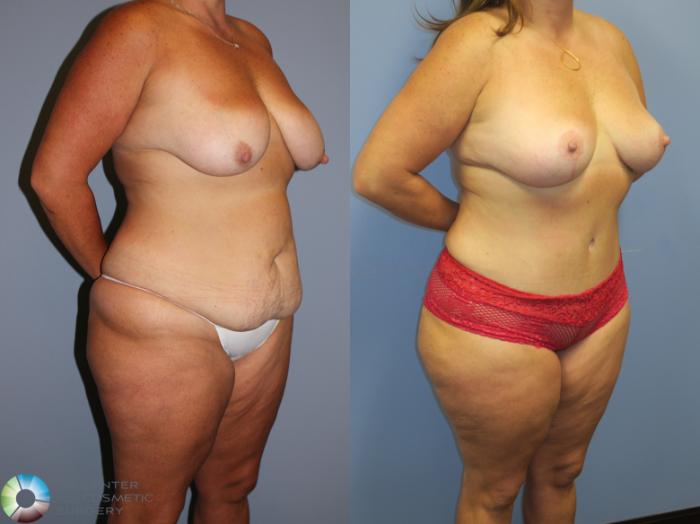 Before & After Tummy Tuck Case 11349 Right Oblique View in Golden, CO