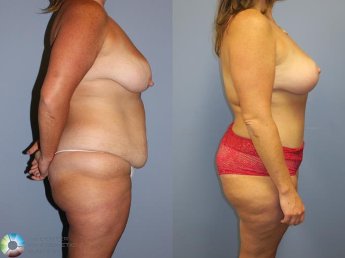 Before & After Tummy Tuck Case 11349 Right Side View in Golden, CO