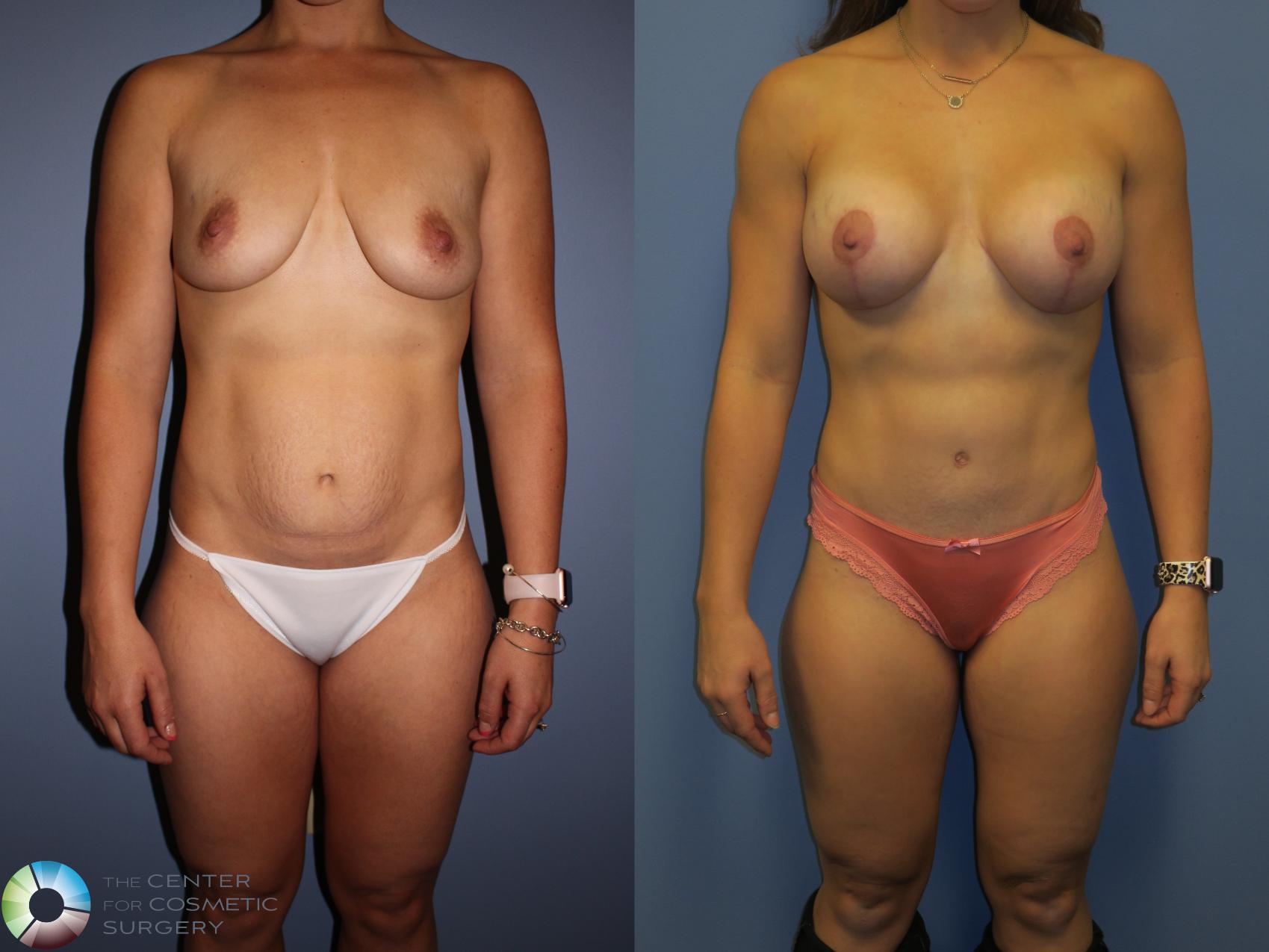 Before & After Tummy Tuck Case 11354 Front in Denver and Colorado Springs, CO