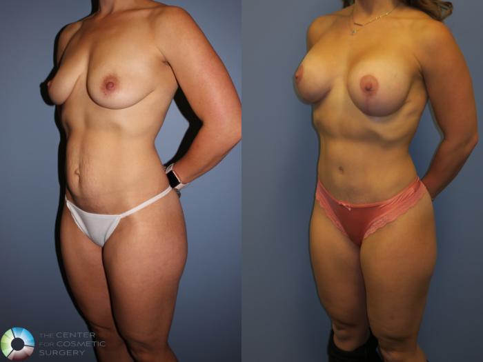 Before & After Mommy Makeover Case 11354 Left Oblique View in Golden, CO