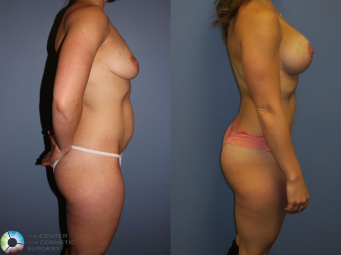 Before & After Mommy Makeover Case 11354 Right Side View in Golden, CO