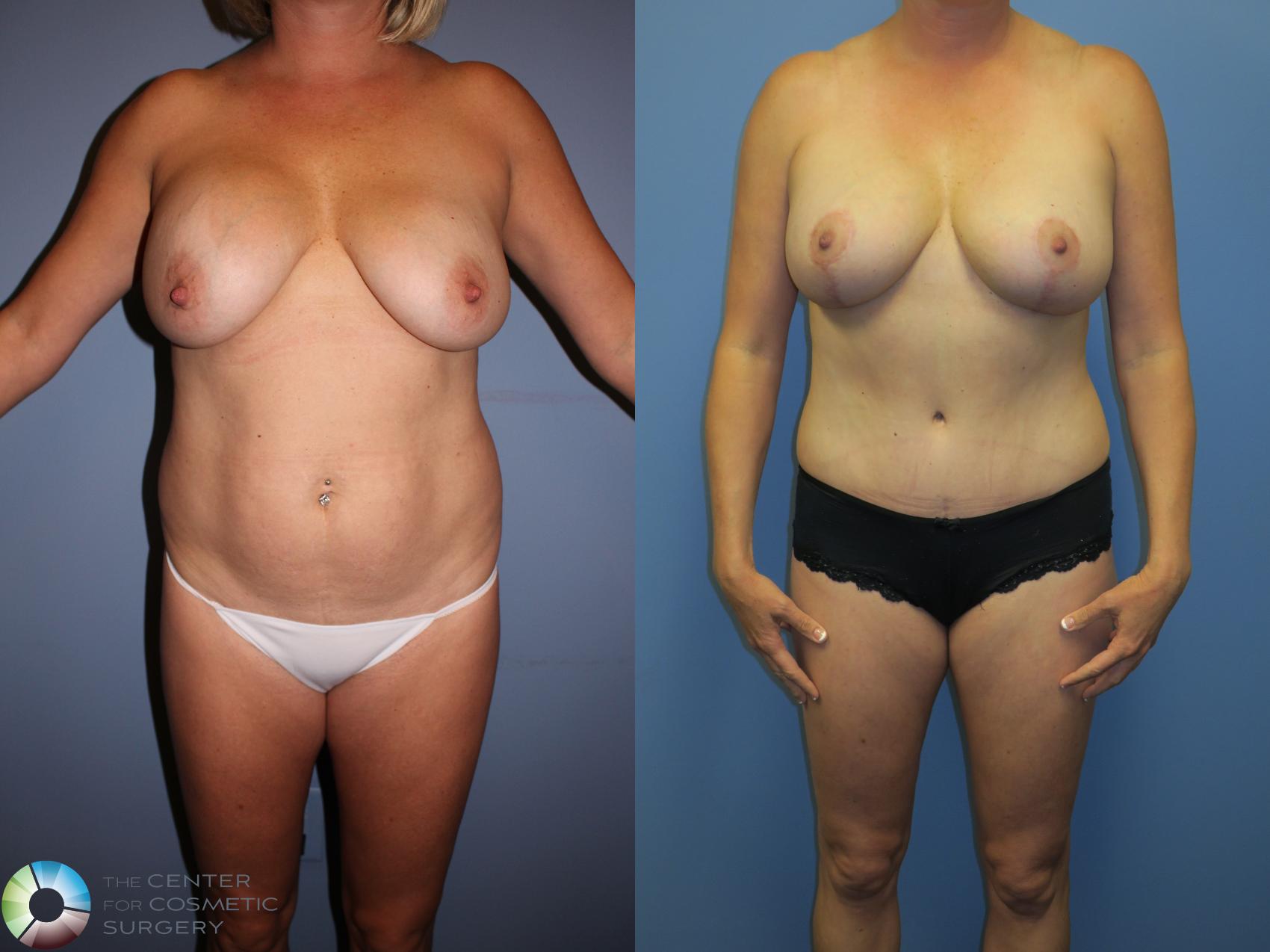 Before & After Breast Implant Revision Case 11357 Front in Denver and Colorado Springs, CO