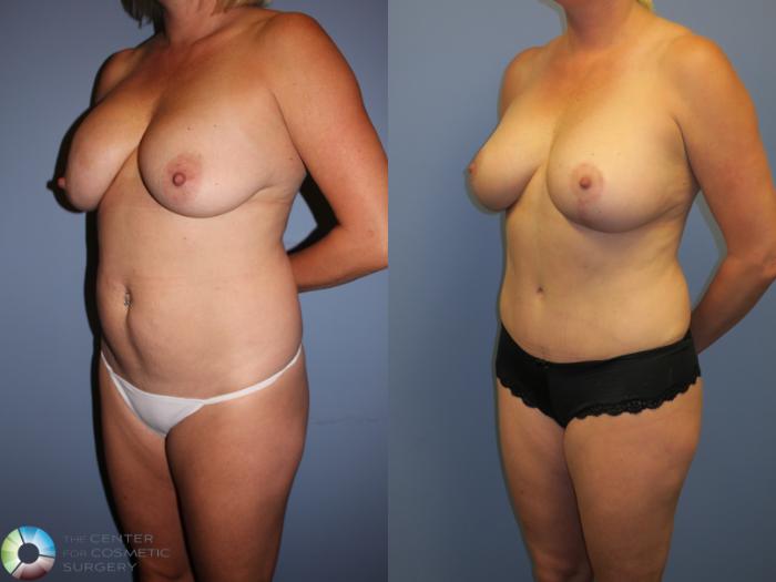 Before & After Tummy Tuck Case 11357 Left Oblique View in Golden, CO