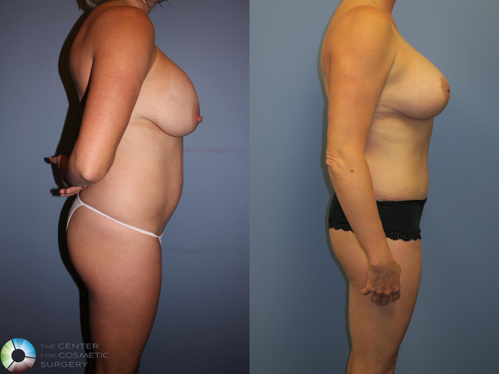Before & After Mommy Makeover Case 11357 Right Side in Denver and Colorado Springs, CO