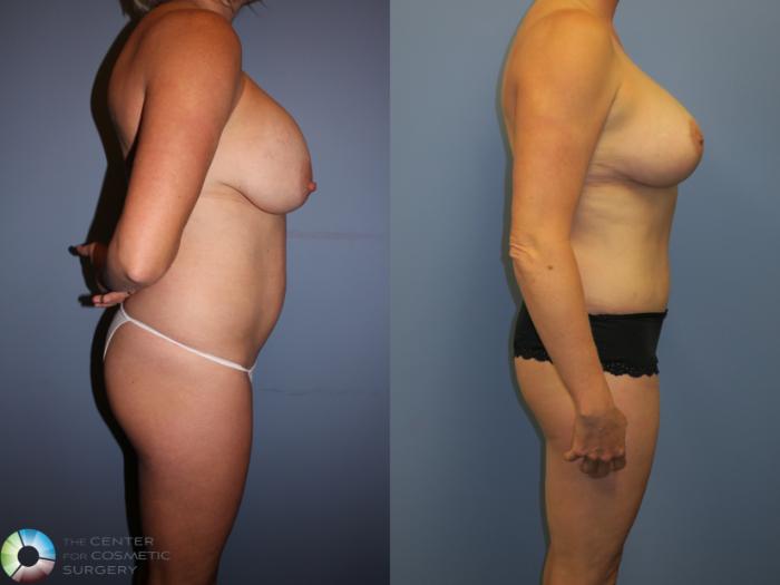 Before & After Tummy Tuck Case 11357 Right Side View in Golden, CO