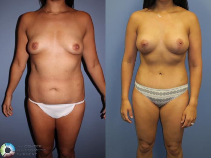 Before & After Tummy Tuck Case 11358 Front in Denver and Colorado Springs, CO