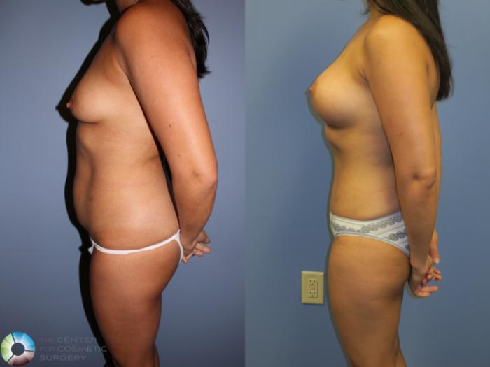 Before & After Tummy Tuck Case 11358 Left Side in Denver and Colorado Springs, CO